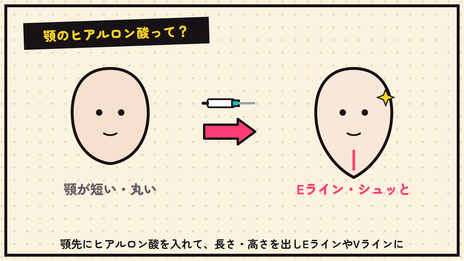 顎ヒアルロン酸の図解（顎に長さ・高さを出す）