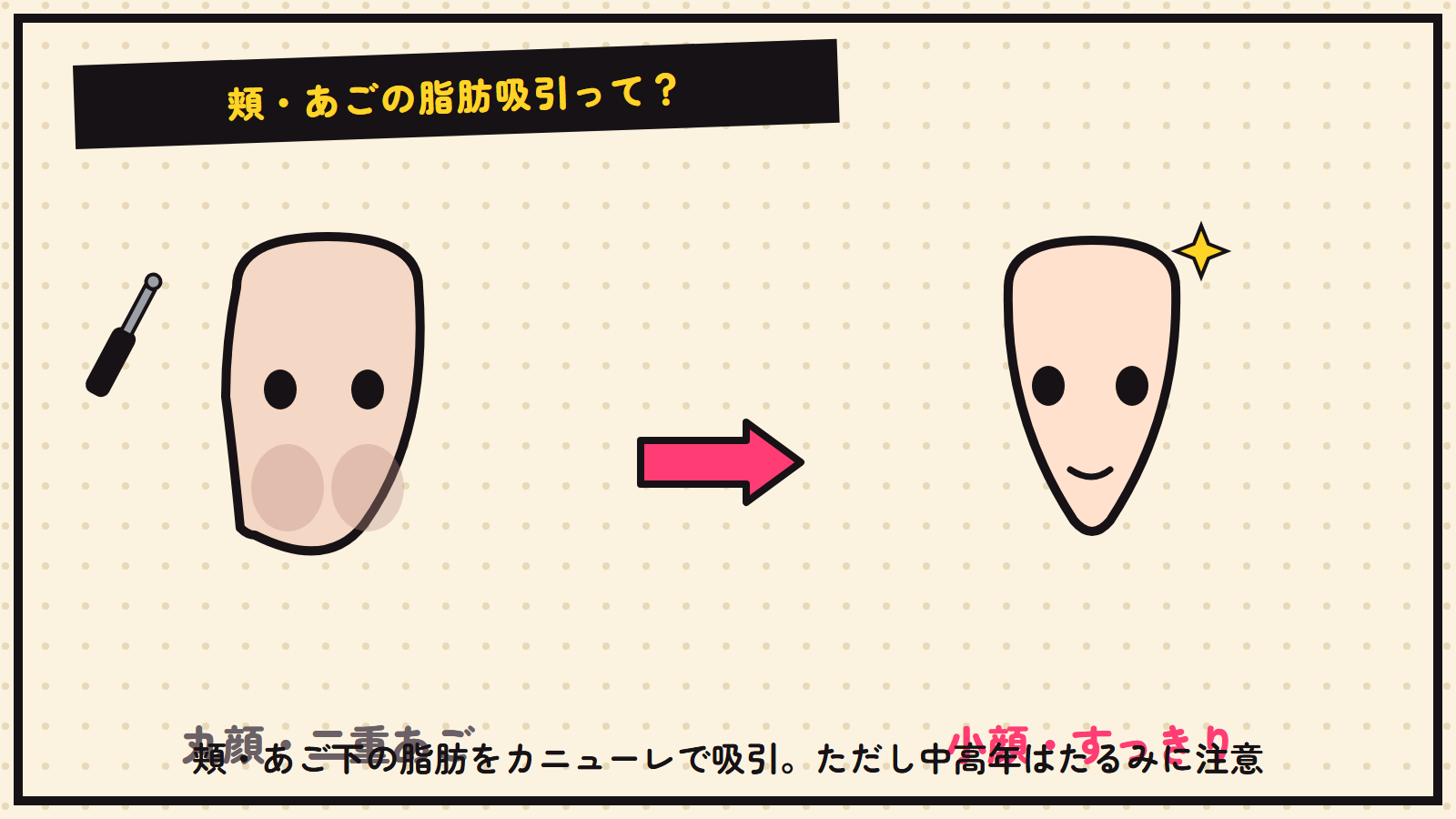 頬・あごの脂肪吸引の図解
