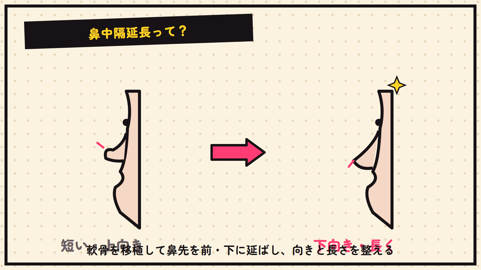 鼻中隔延長の図解（鼻先を下に延ばす）
