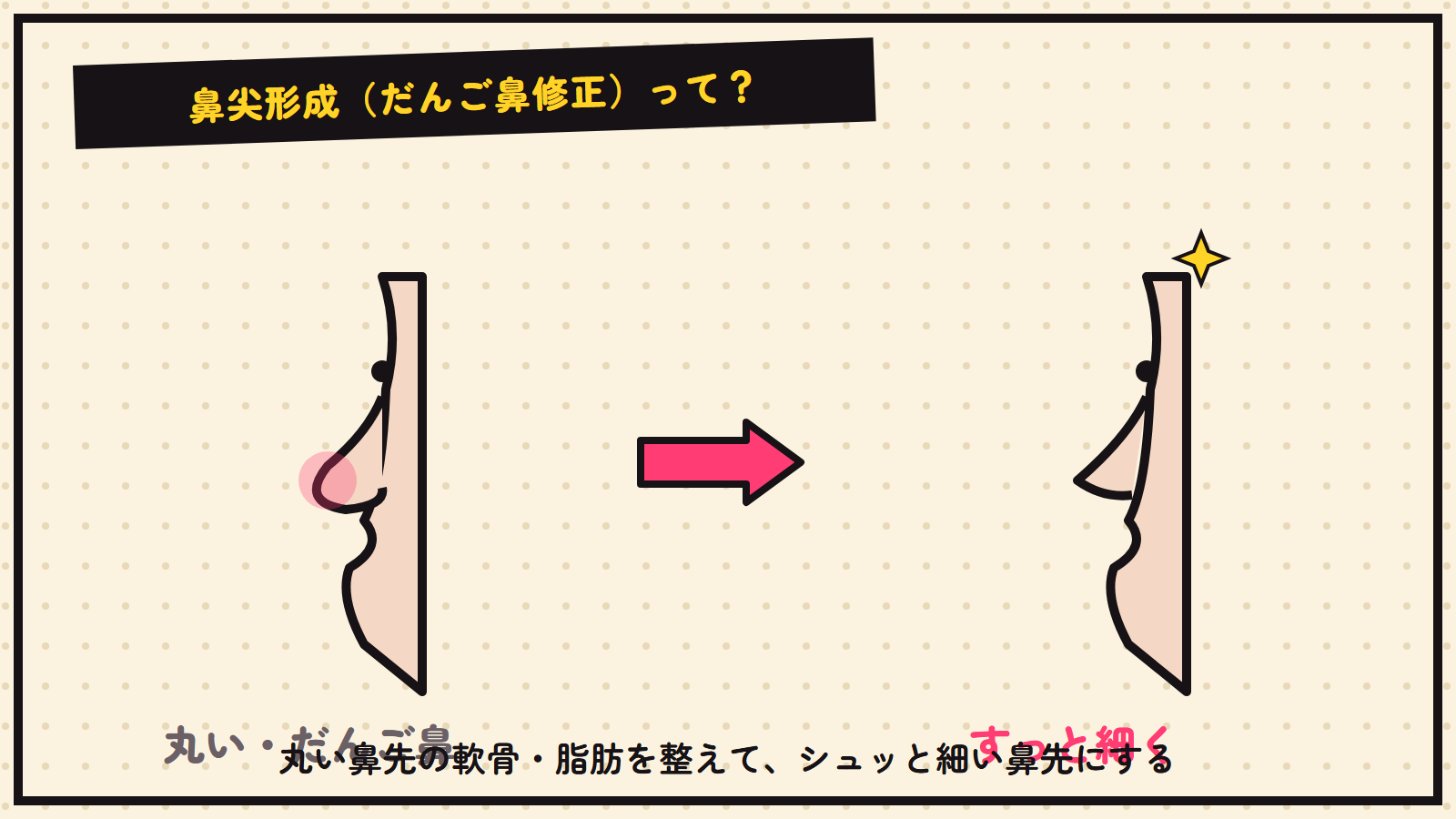 鼻尖形成の図解（だんご鼻を細く）