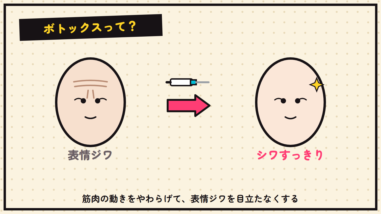 ボトックスの図解（表情ジワ→すっきり）