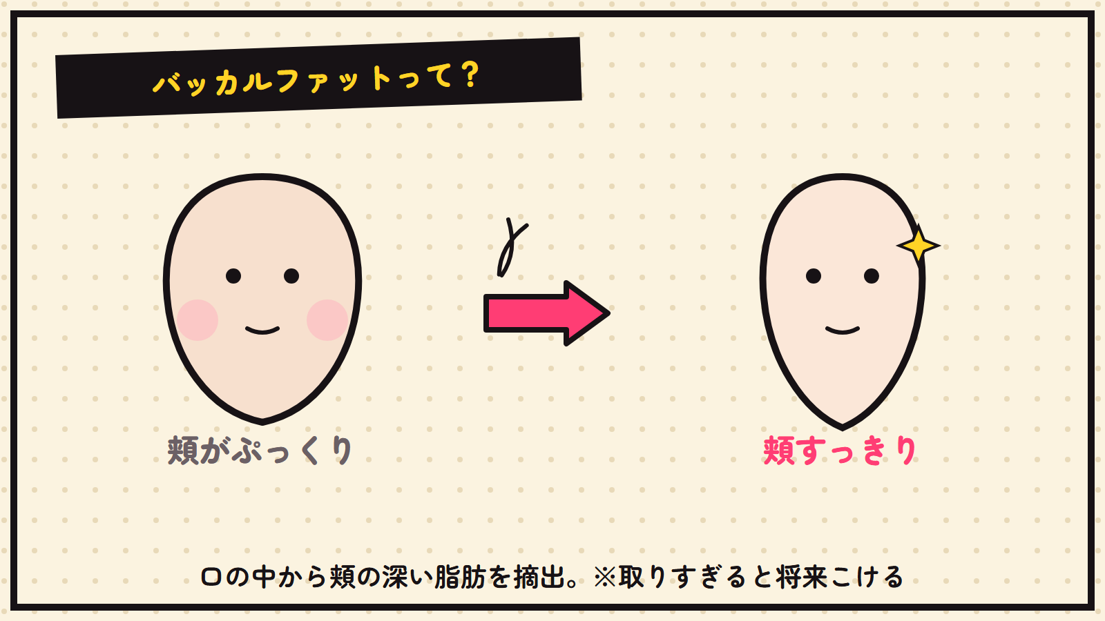 バッカルファットの図解（頬の脂肪を取る）