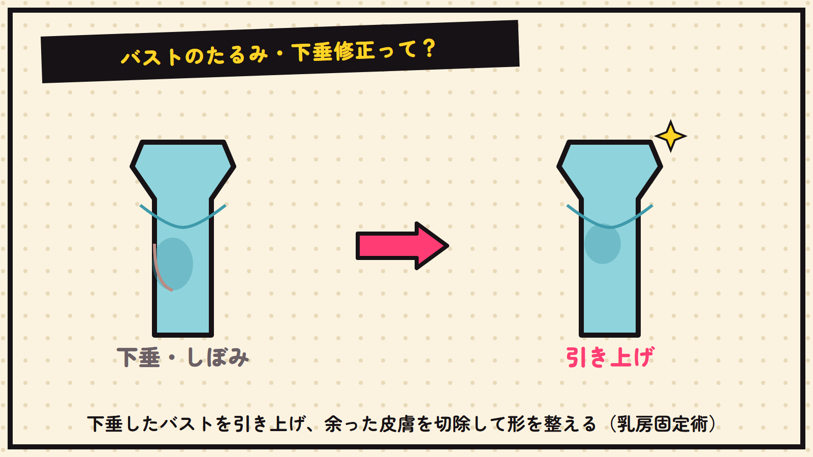 バストのたるみ・下垂修正の図解（抽象）
