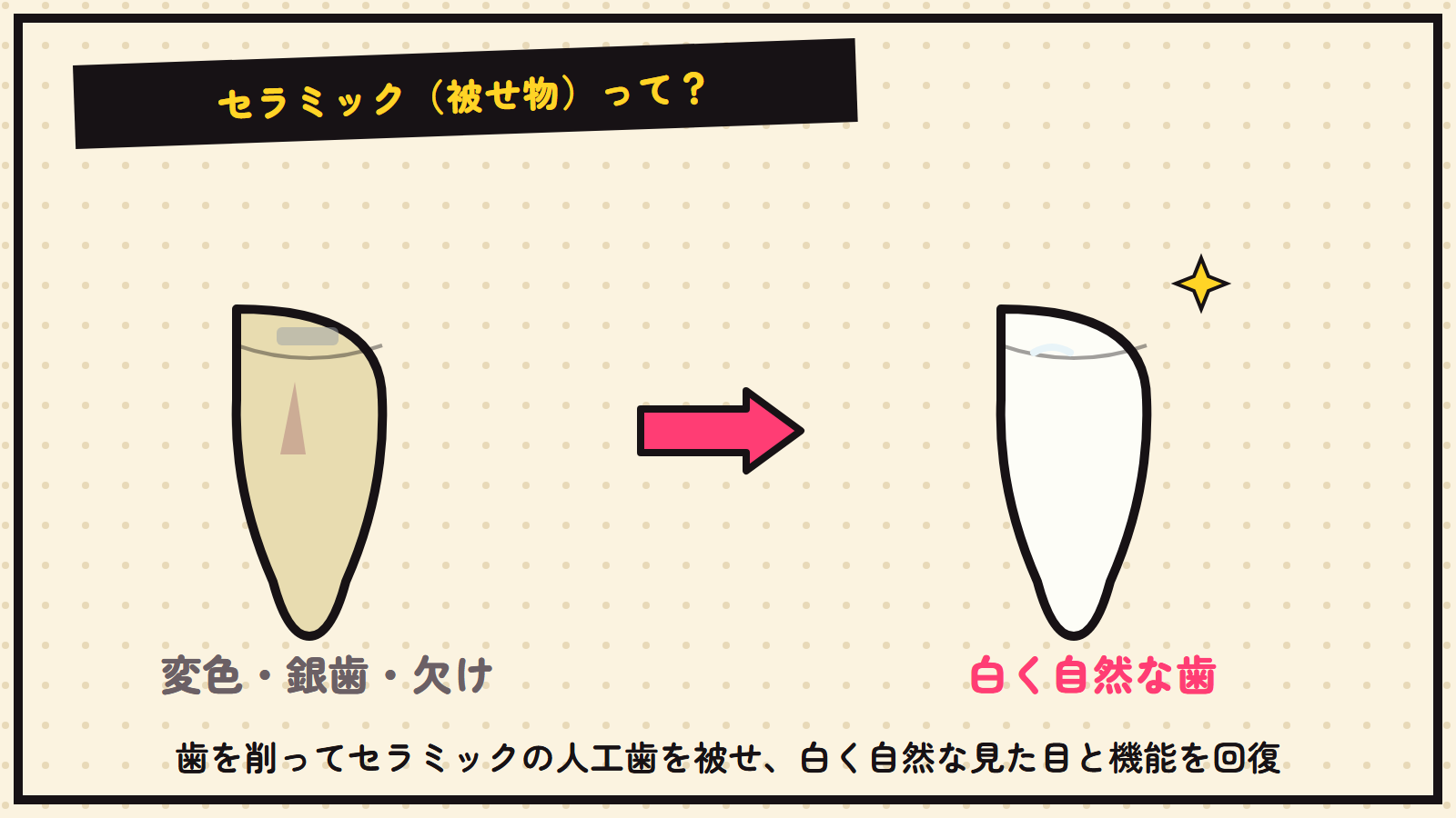 セラミック（被せ物）の図解
