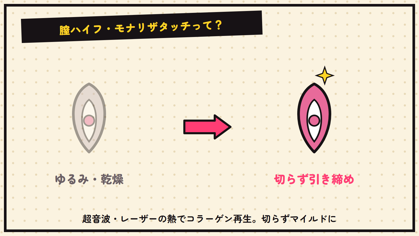 膣ハイフの図解（抽象）
