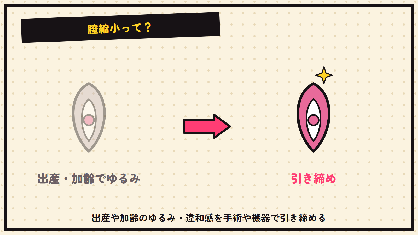 膣縮小の図解（抽象）
