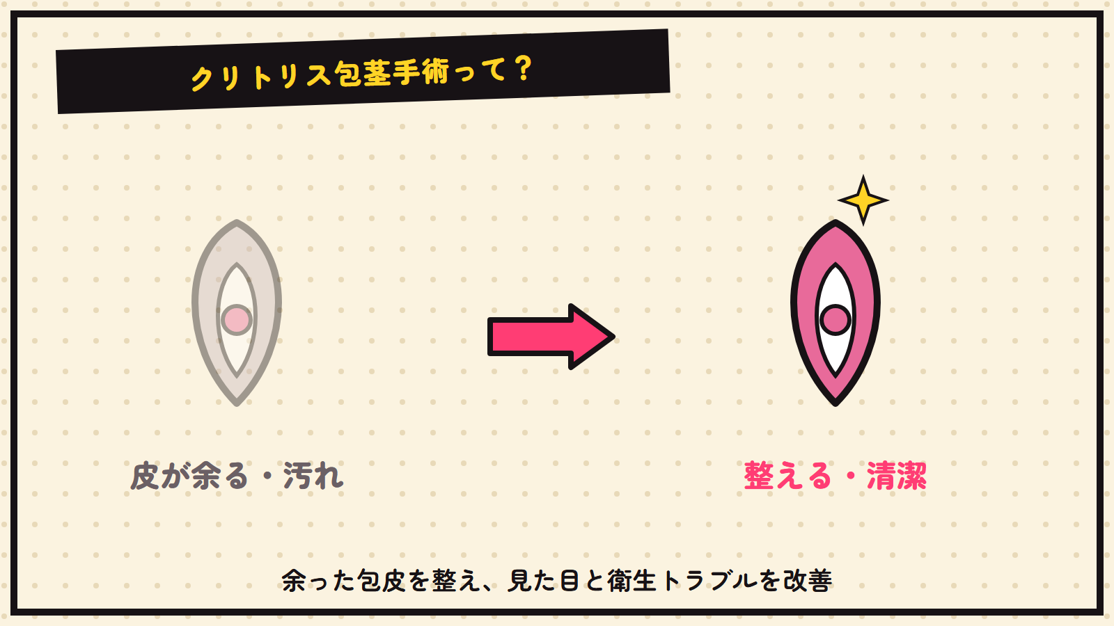 クリトリス包茎手術の図解（抽象）