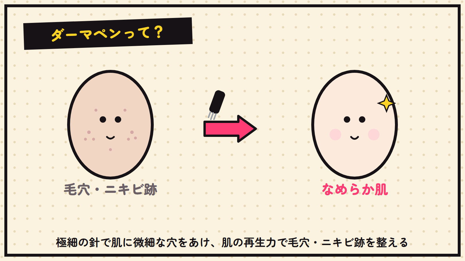 ダーマペンの図解（毛穴・ニキビ跡→なめらか肌）