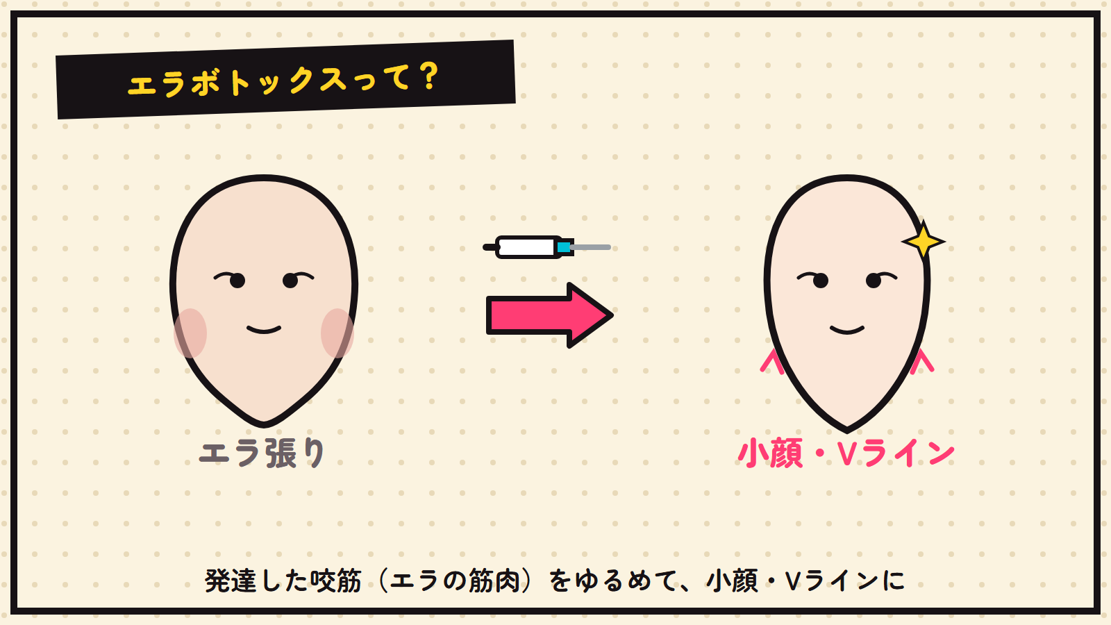 エラボトックスの図解（エラ張り→小顔Vライン）
