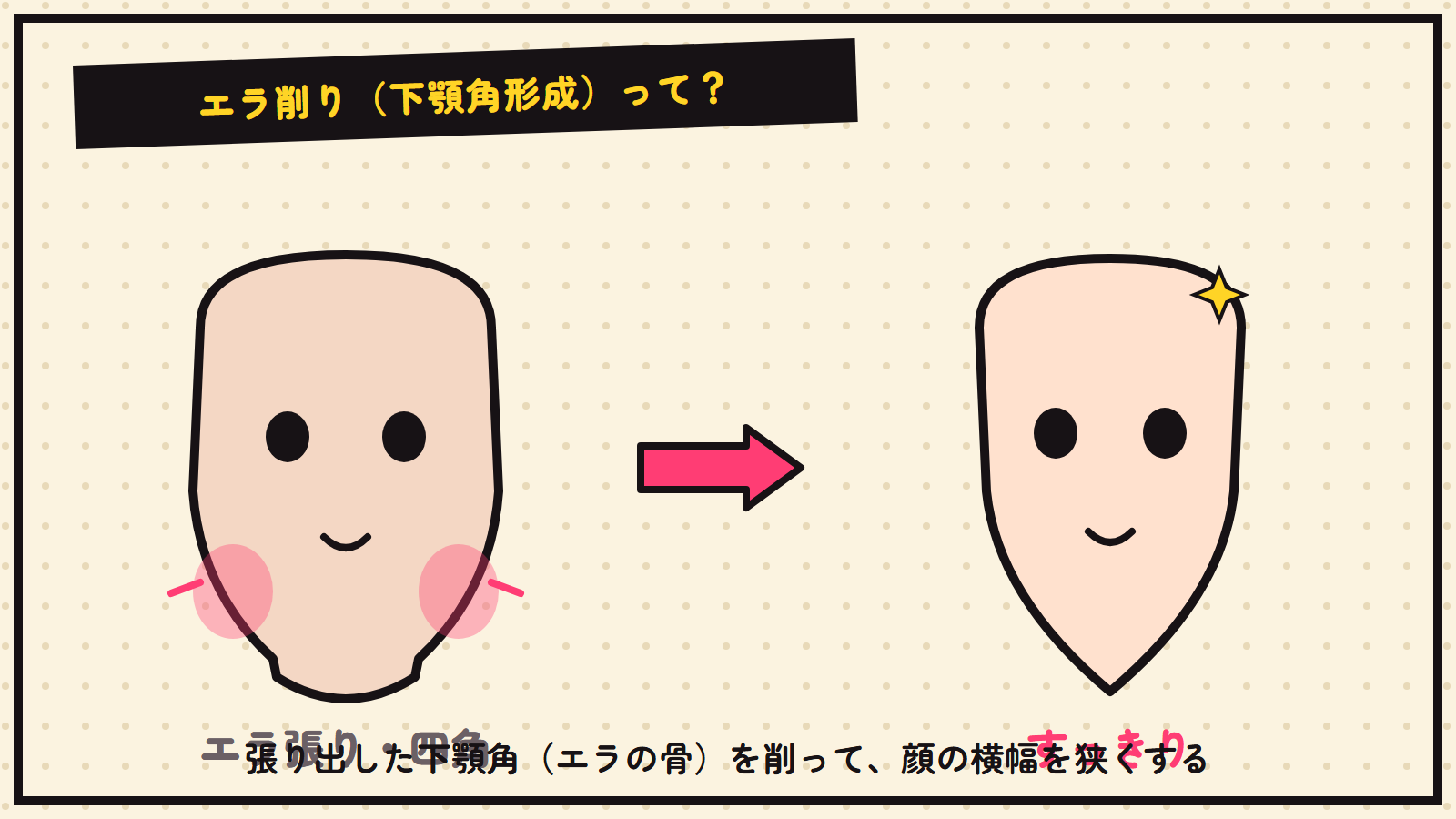 エラ削りの図解（下顎角を削る）