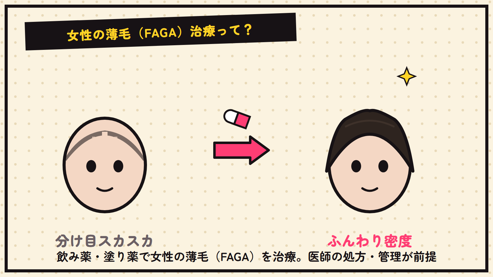 女性の薄毛（FAGA）治療の図解