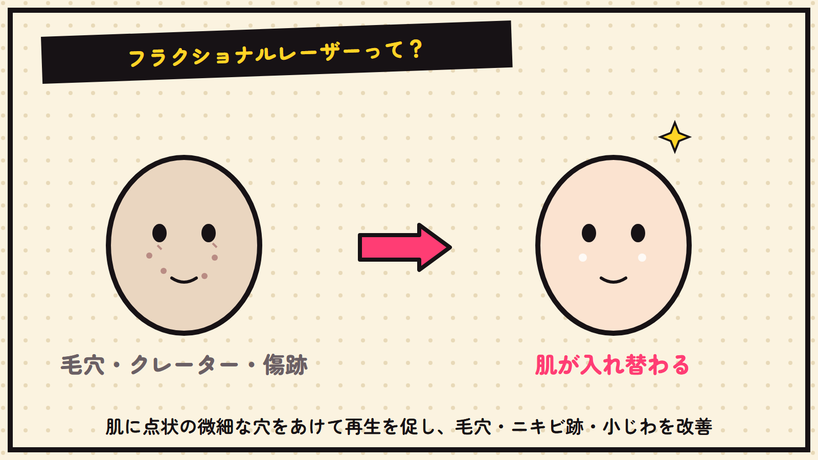 フラクショナルレーザーの図解