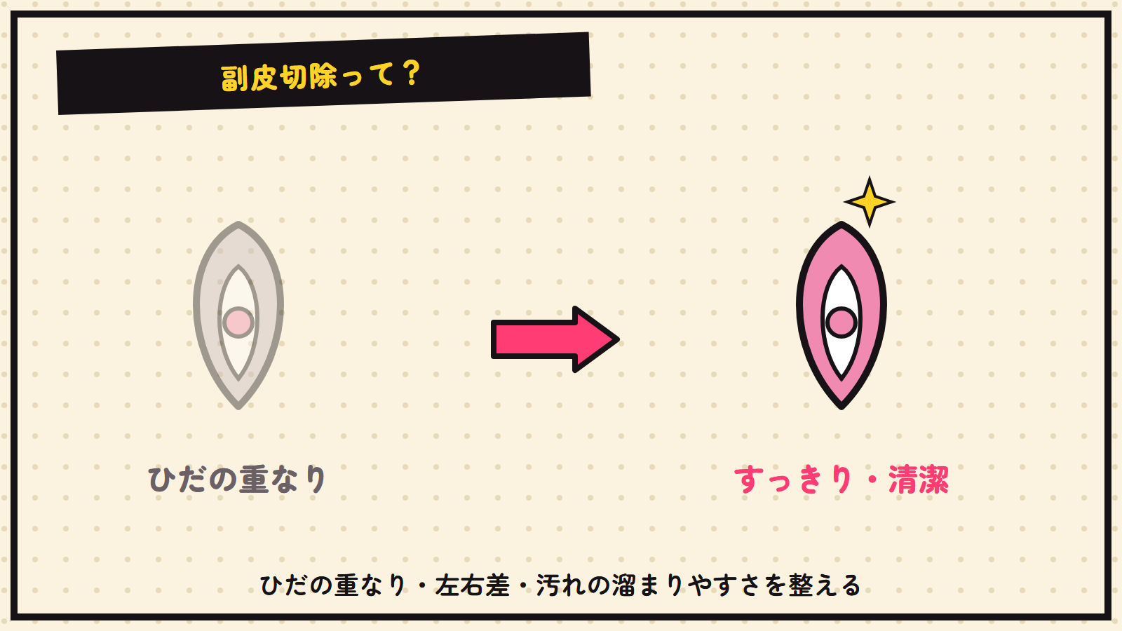 副皮切除の図解（抽象）