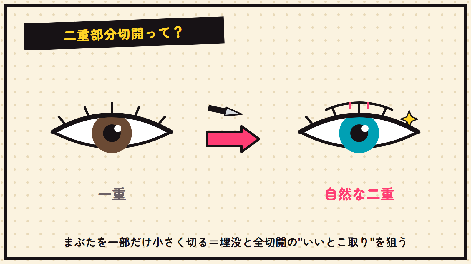 二重部分切開の図解（一部だけ切って二重に）