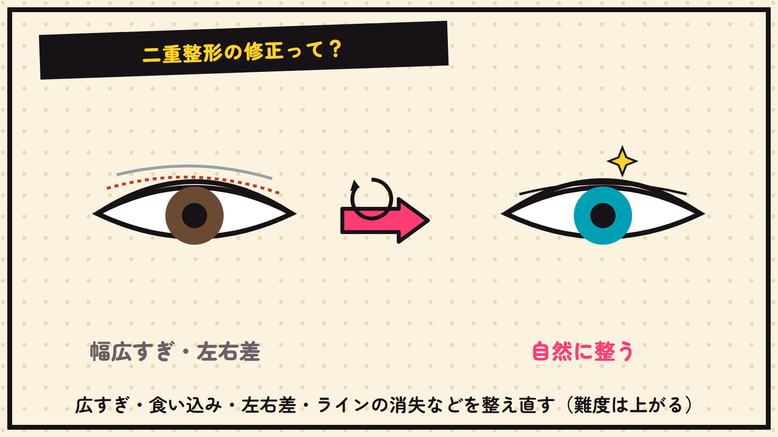 二重整形の修正の図解