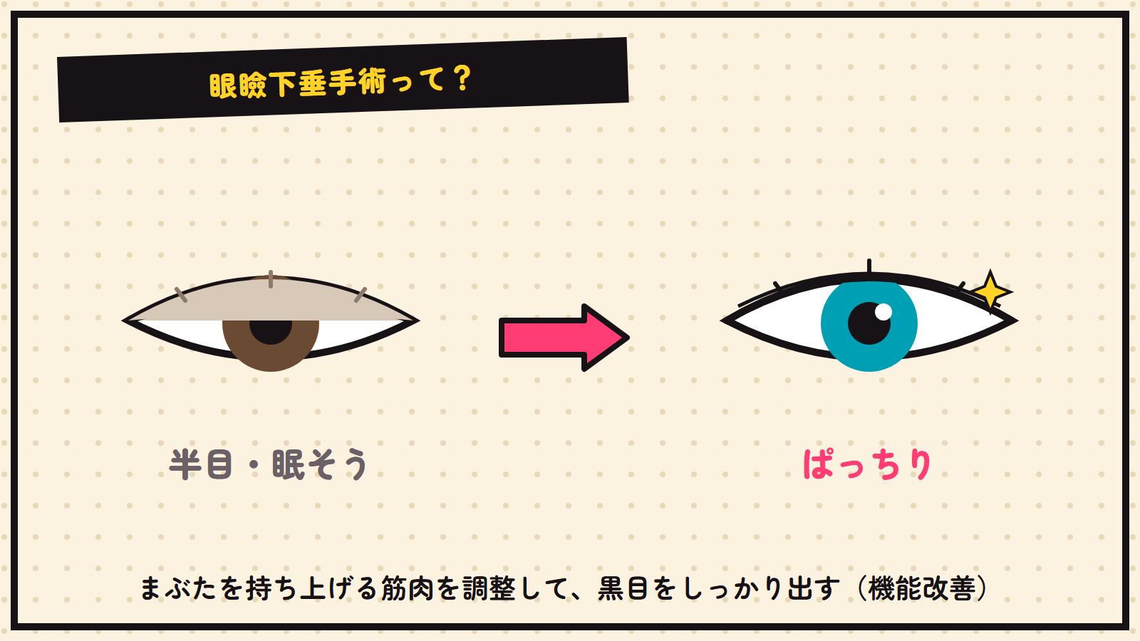 眼瞼下垂手術の図解（まぶたを持ち上げる）