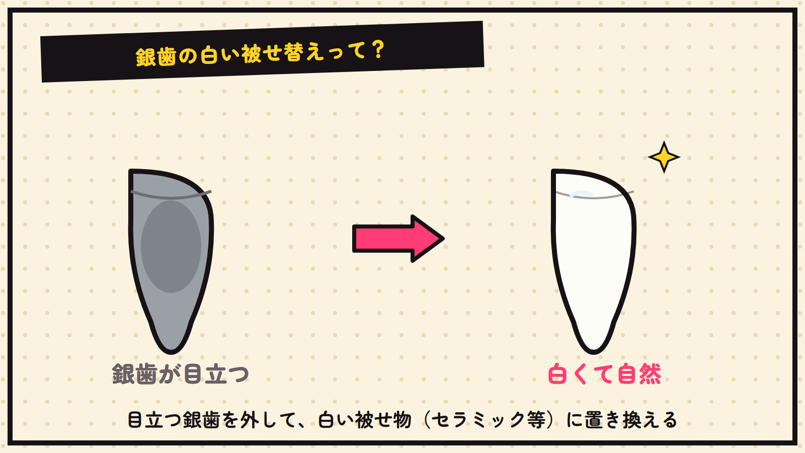 銀歯の白い被せ替えの図解