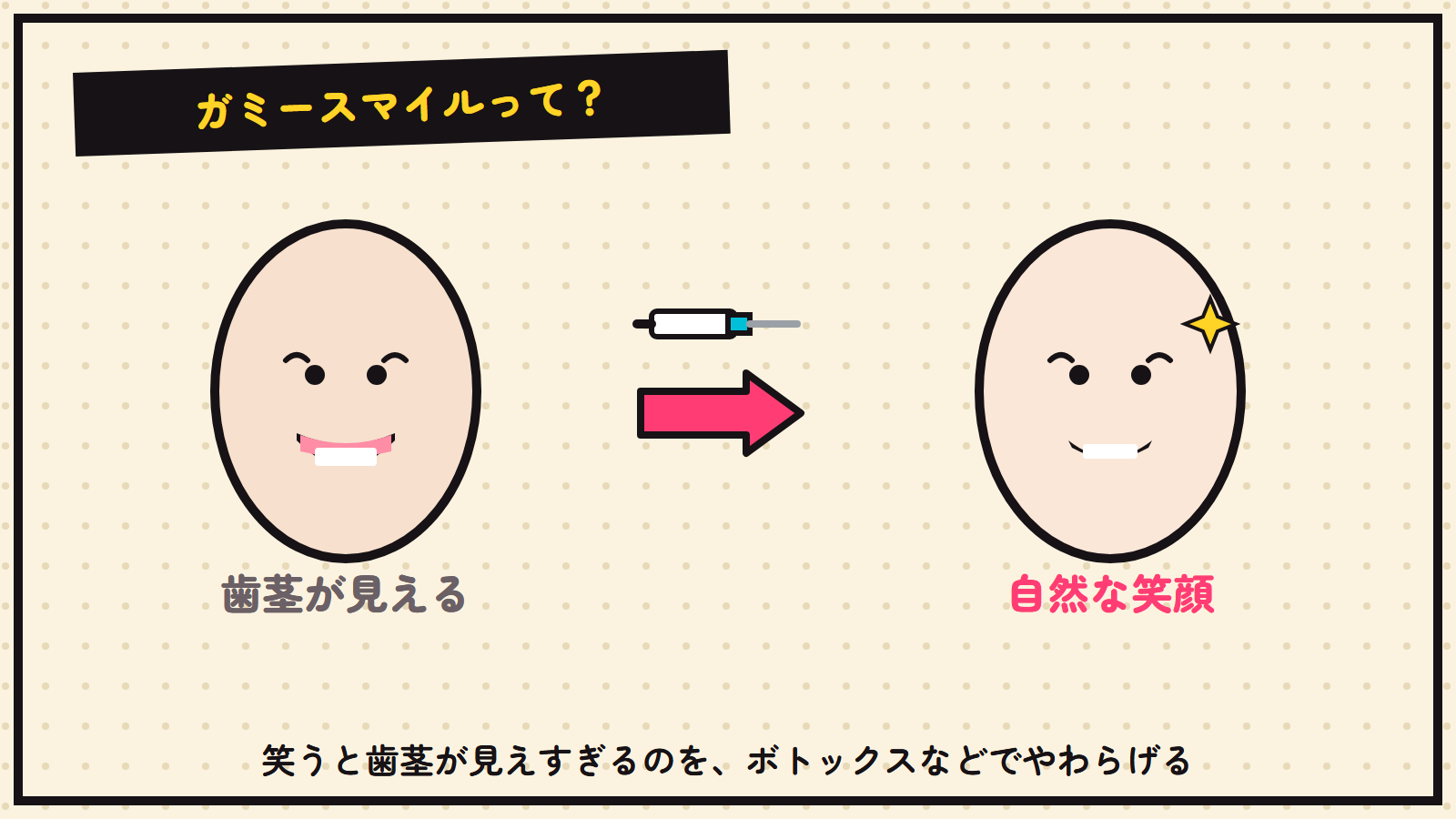 ガミースマイルの図解（歯茎の見えすぎを整える）