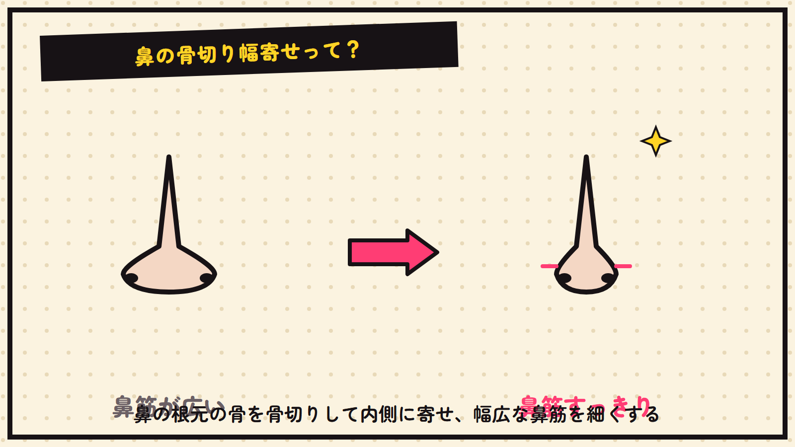 鼻の骨切り幅寄せの図解（鼻筋を細く）