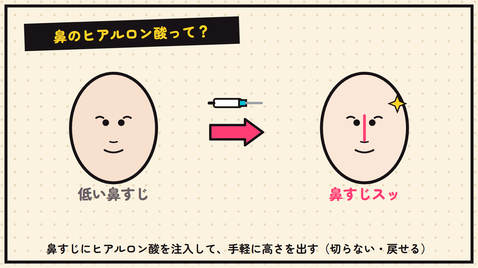 鼻のヒアルロン酸の図解（鼻すじに注入して高さを出す）