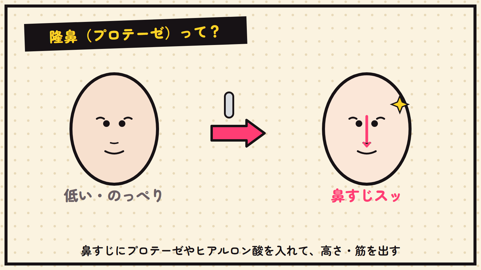 隆鼻の図解（低い鼻→鼻すじを通す）