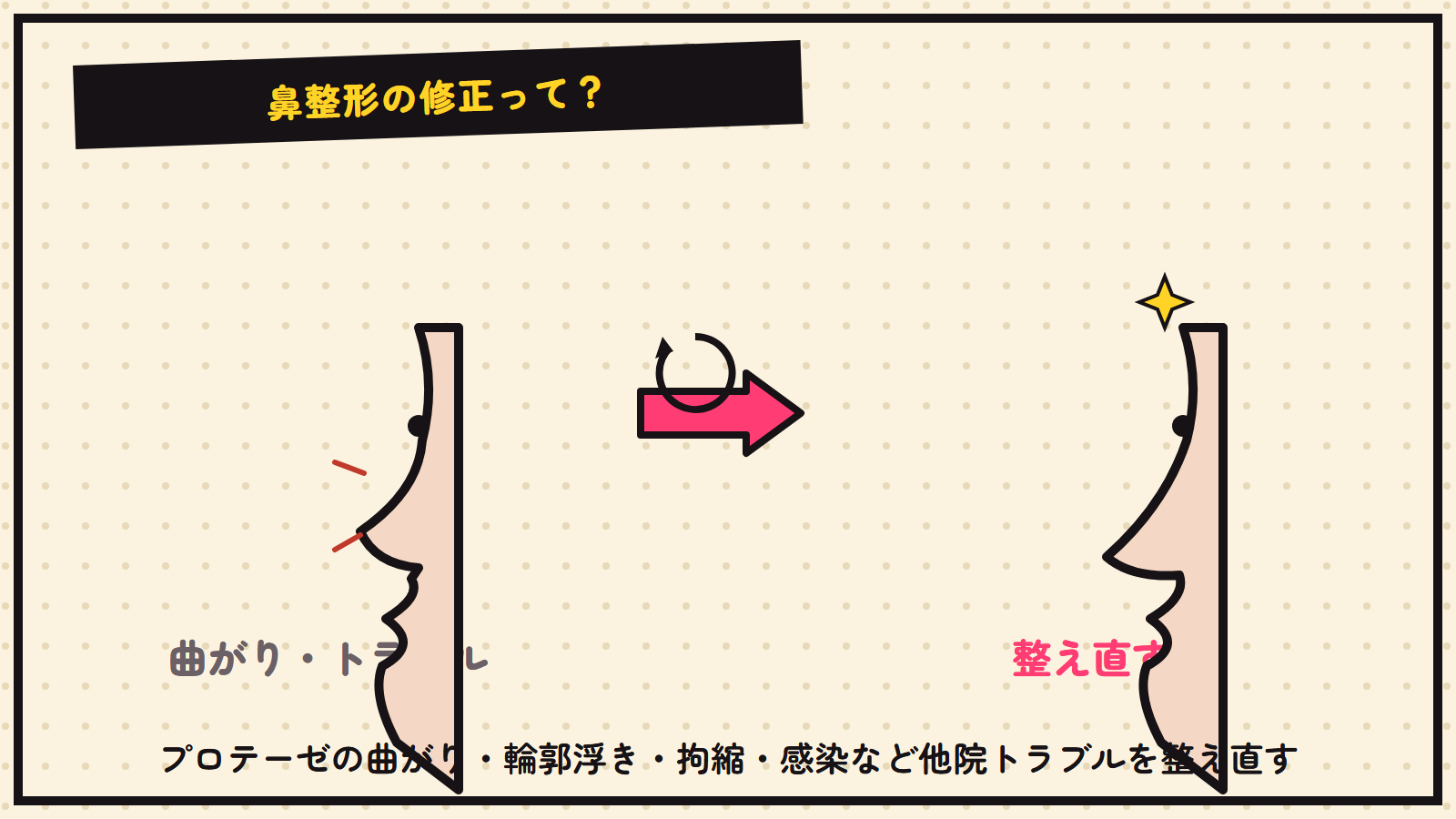 鼻整形の修正の図解