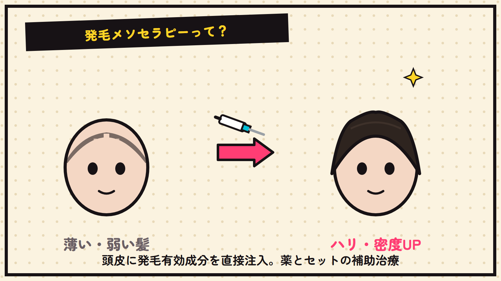 発毛メソセラピーの図解