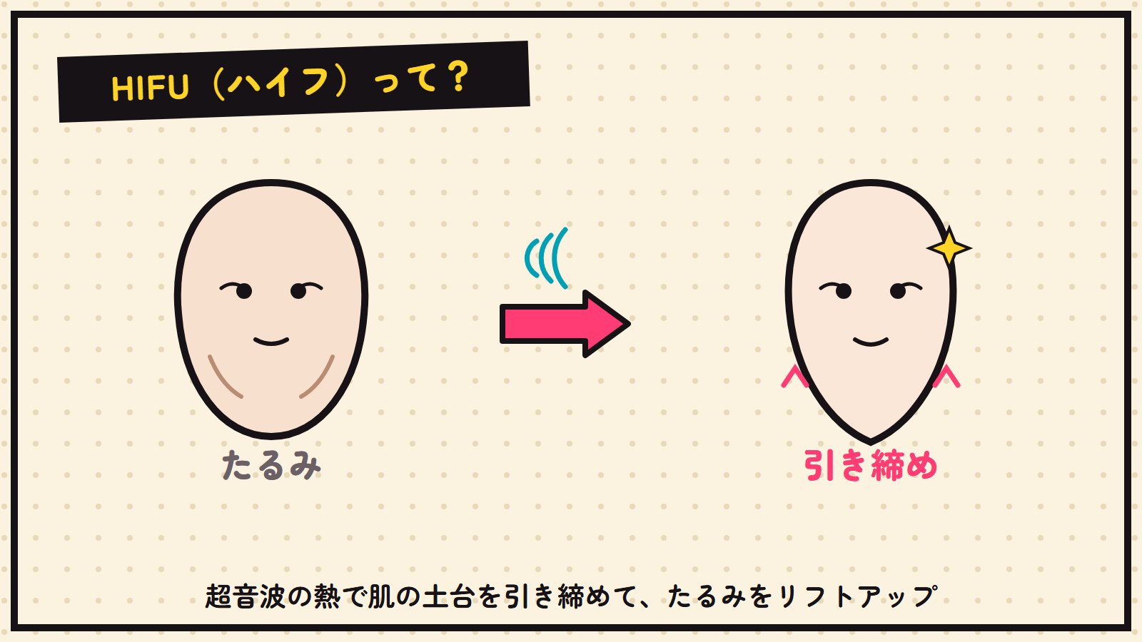 HIFUの図解（たるみ→引き締め）