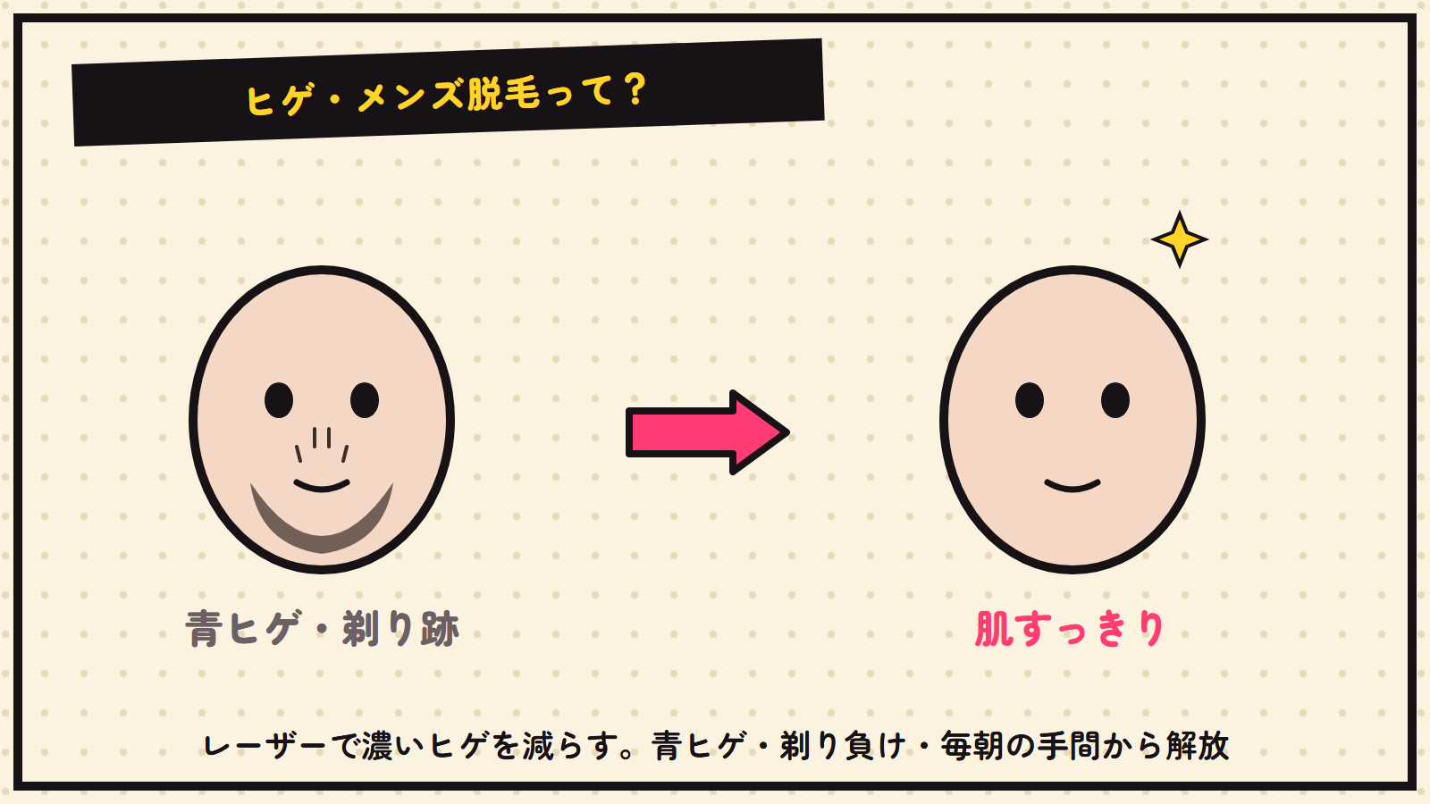 ヒゲ・メンズ脱毛の図解