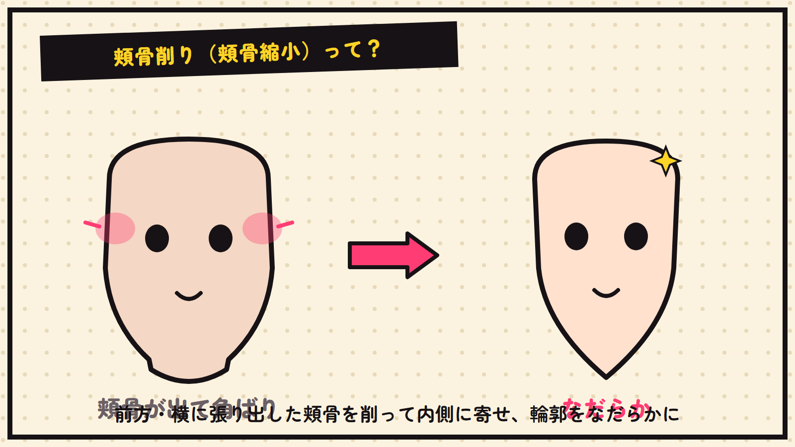 頬骨削りの図解（頬骨を内側へ）