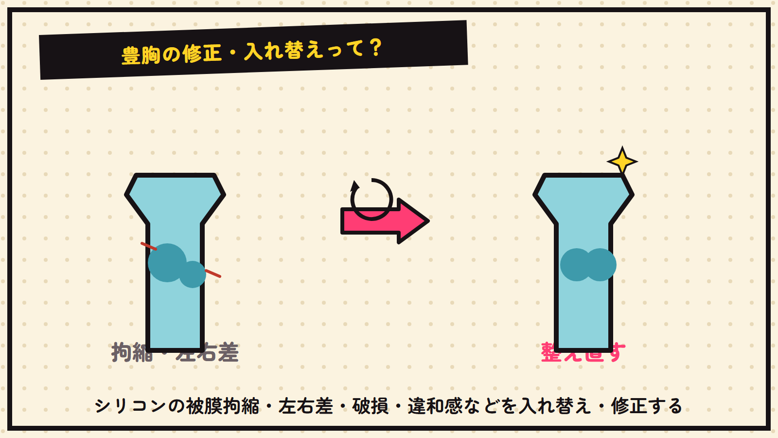 豊胸の修正・入れ替えの図解
