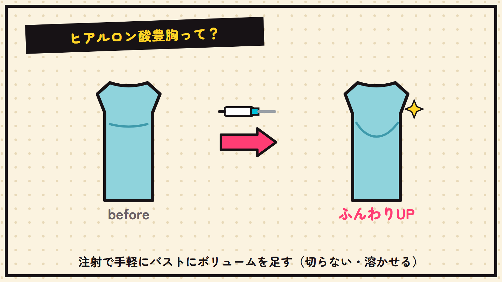 ヒアルロン酸豊胸の図解（注射でふんわりバストUP）