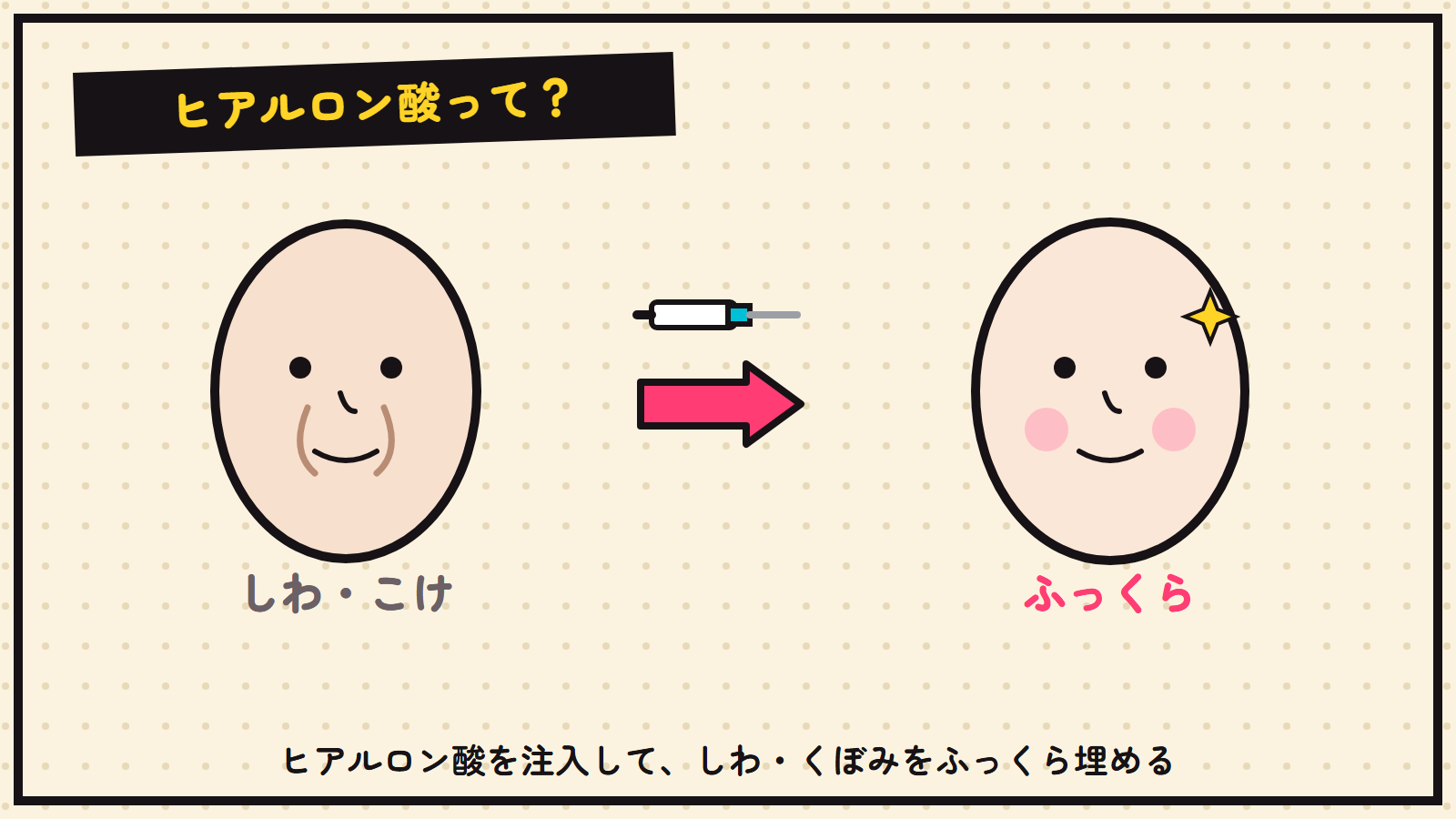 ヒアルロン酸注入の図解（しわ・こけ→ふっくら）