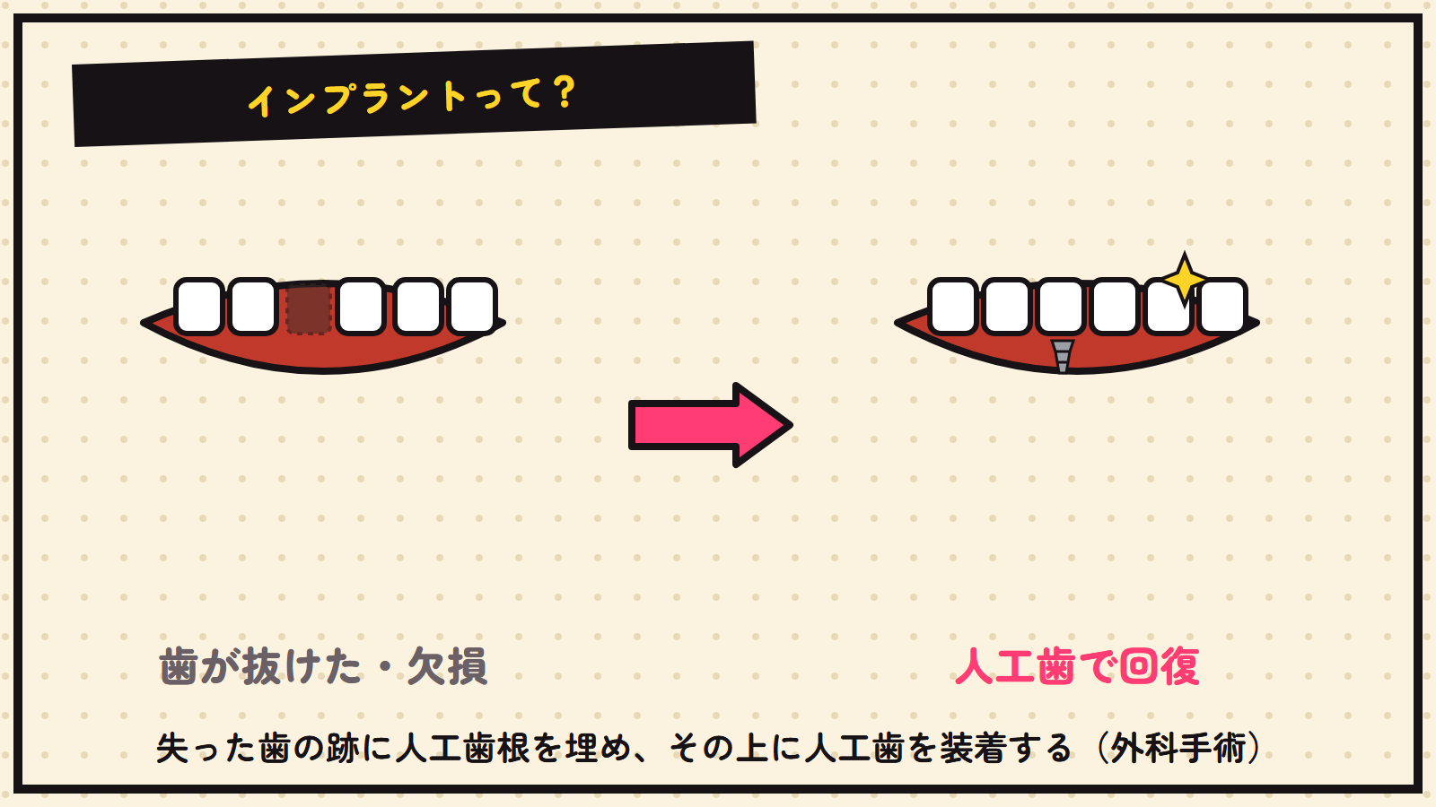 インプラントの図解