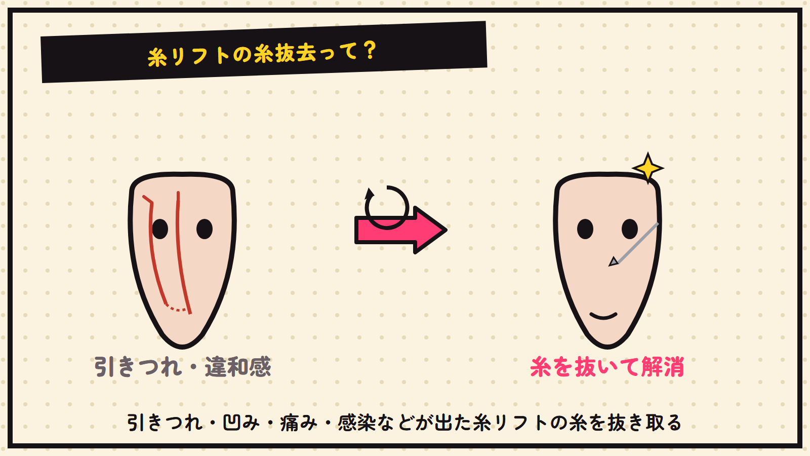糸リフトの糸抜去の図解