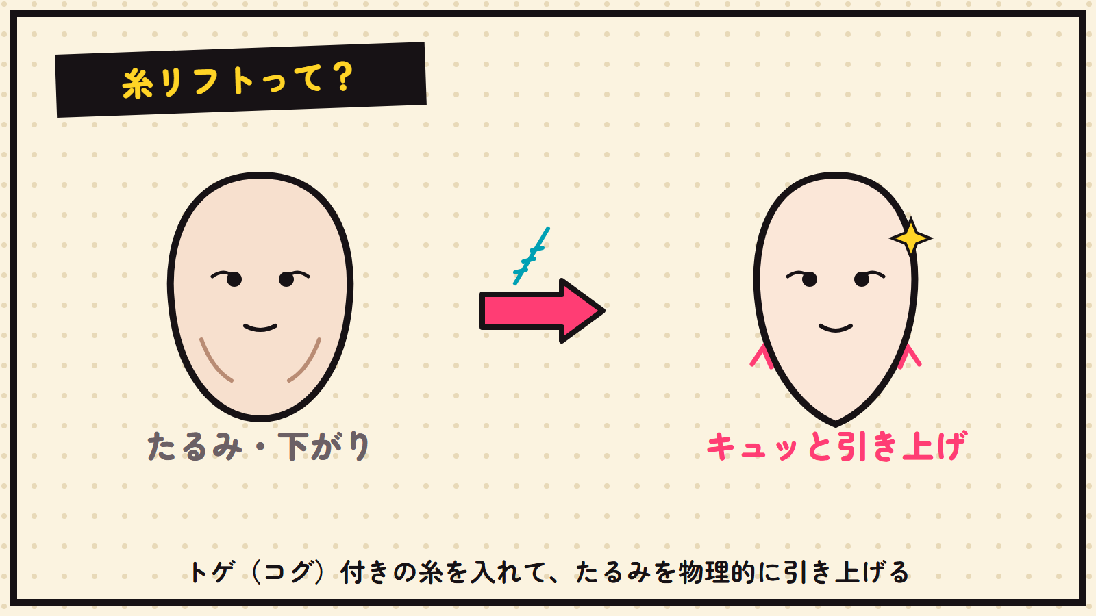 糸リフトの図解（たるみを糸で引き上げ）