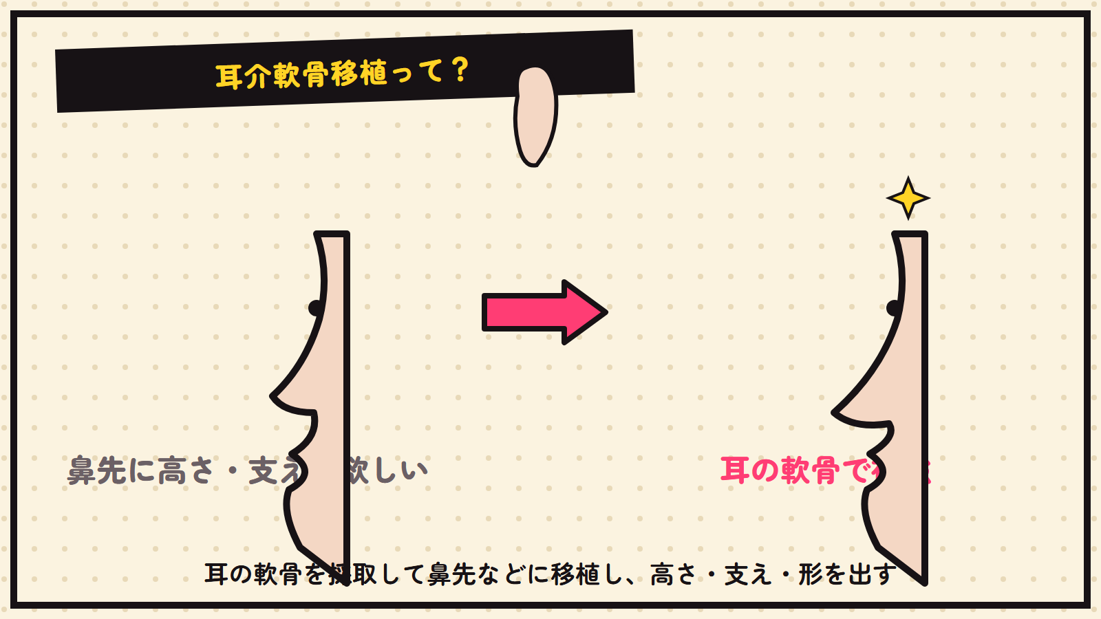 耳介軟骨移植の図解