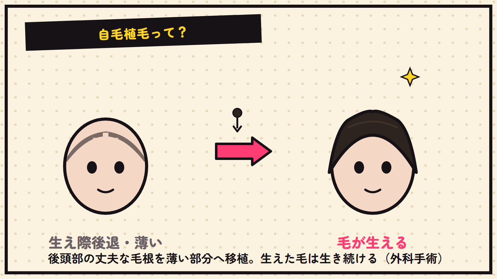 自毛植毛の図解