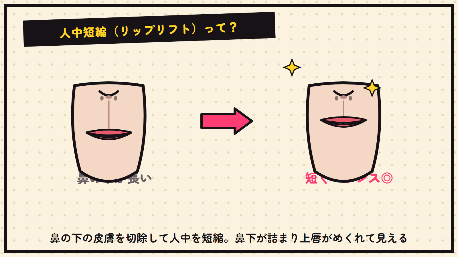 人中短縮（リップリフト）の図解
