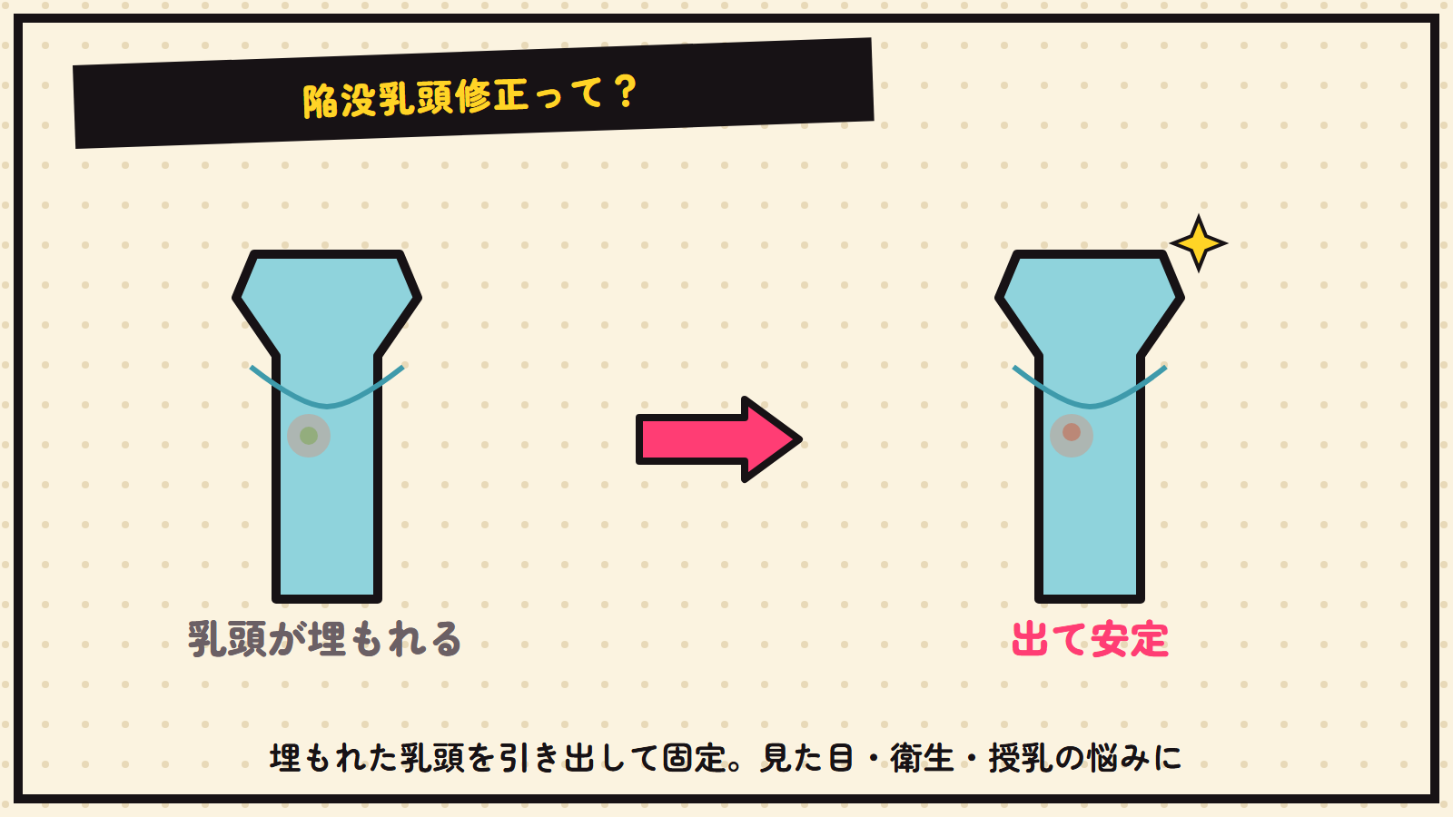 陥没乳頭修正の図解（抽象）