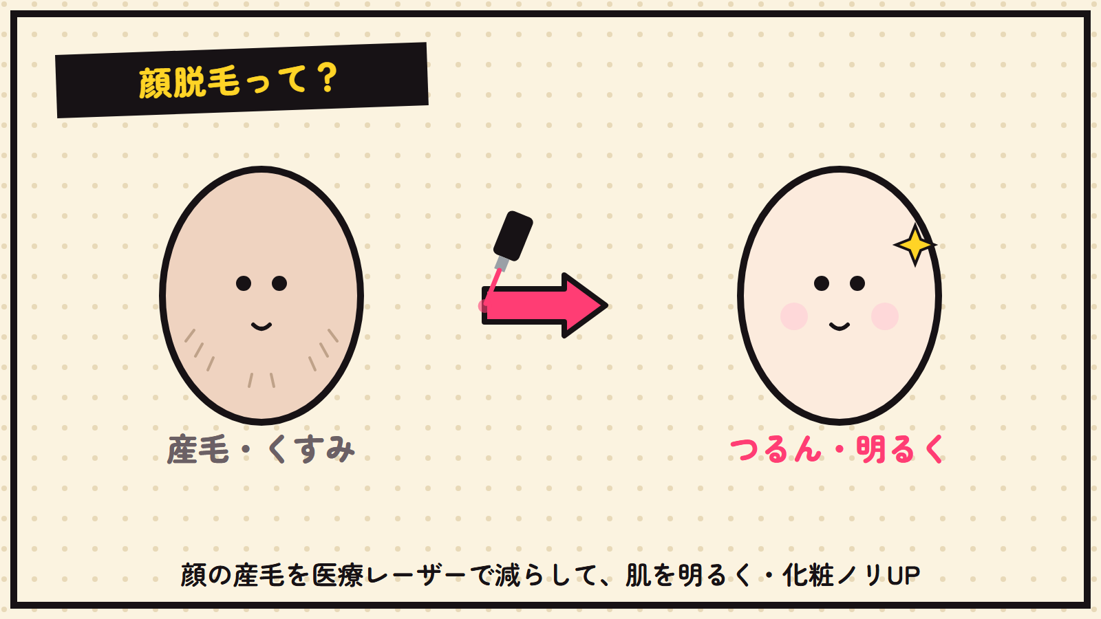 顔脱毛の図解（産毛→つるん明るく）