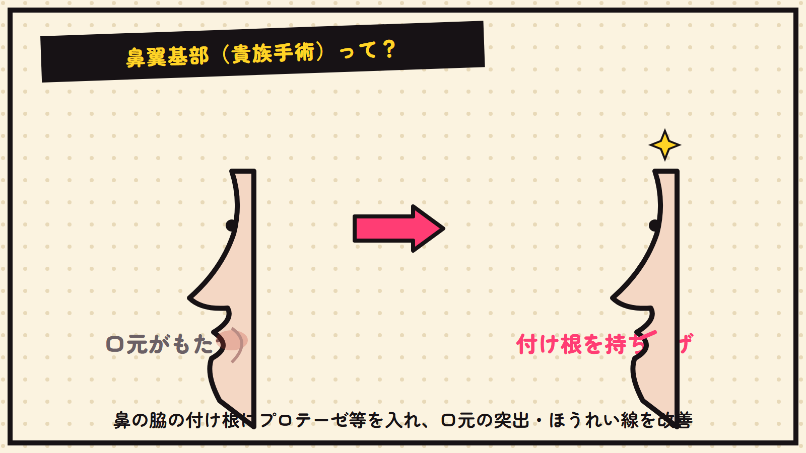 貴族手術（鼻翼基部）の図解