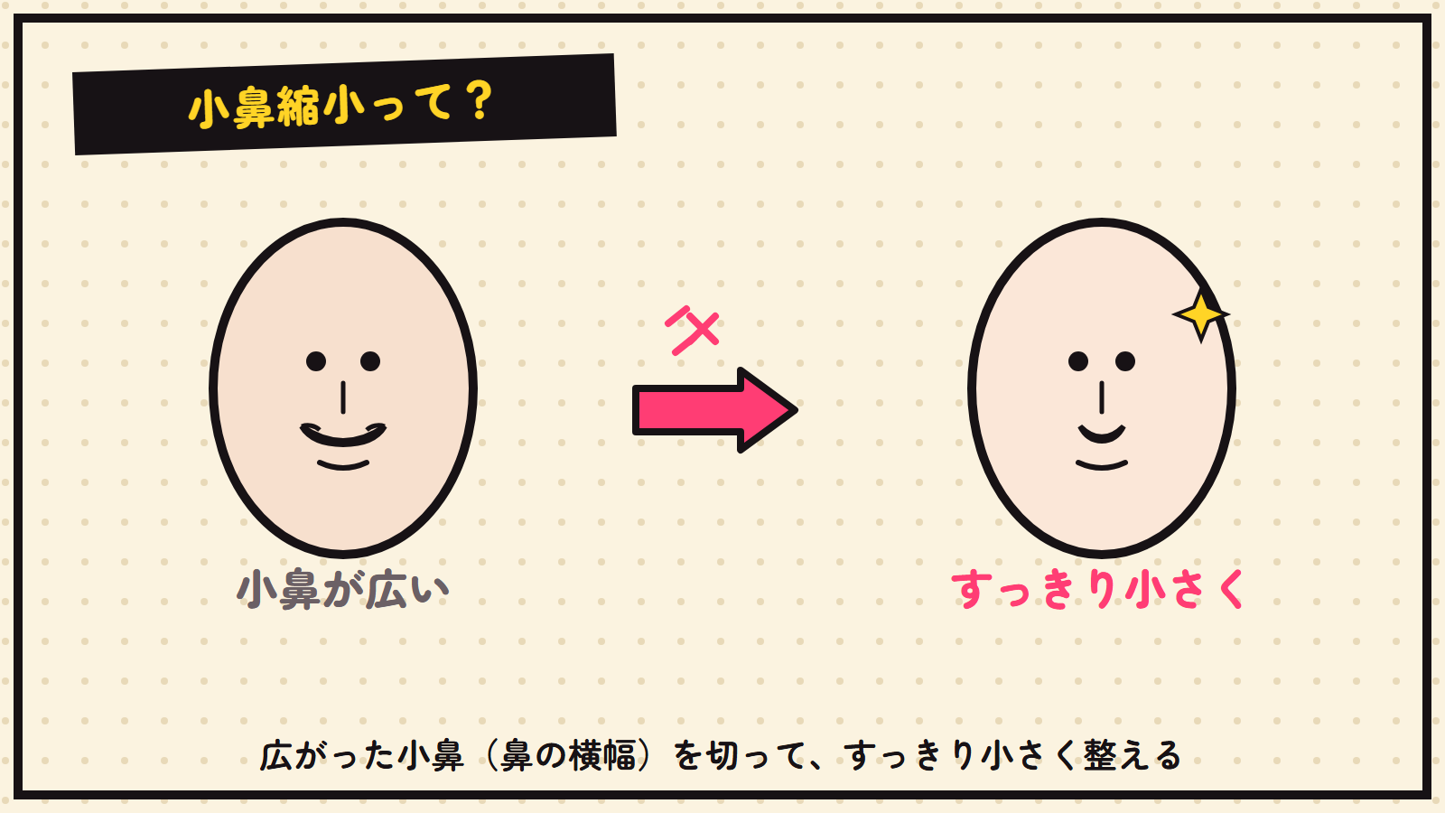 小鼻縮小の図解（広がった小鼻→すっきり）