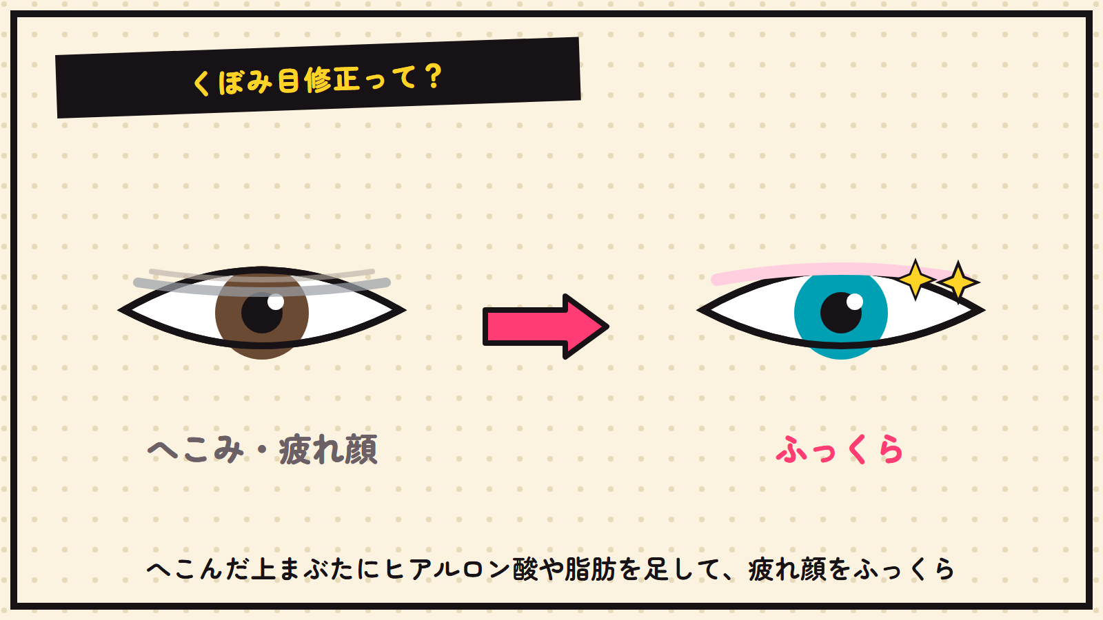 くぼみ目修正の図解（ふっくらさせる）