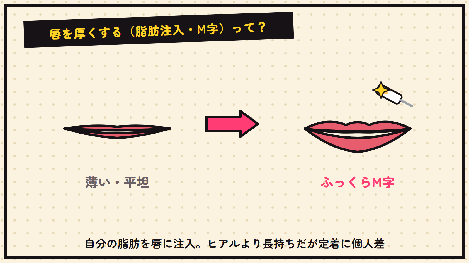 唇の脂肪注入（M字リップ）の図解