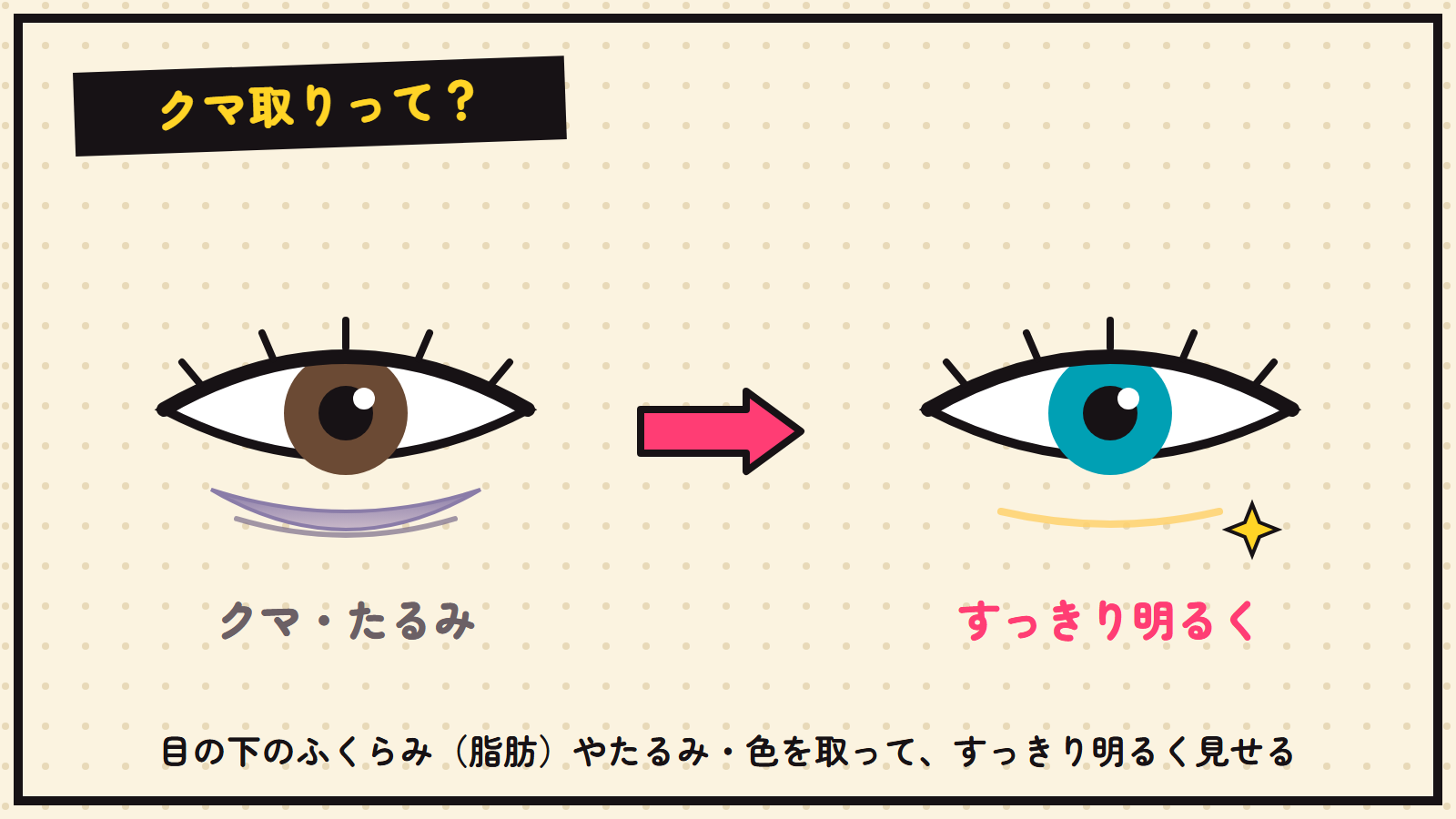 クマ取りの図解（目の下のたるみ・クマをすっきり）
