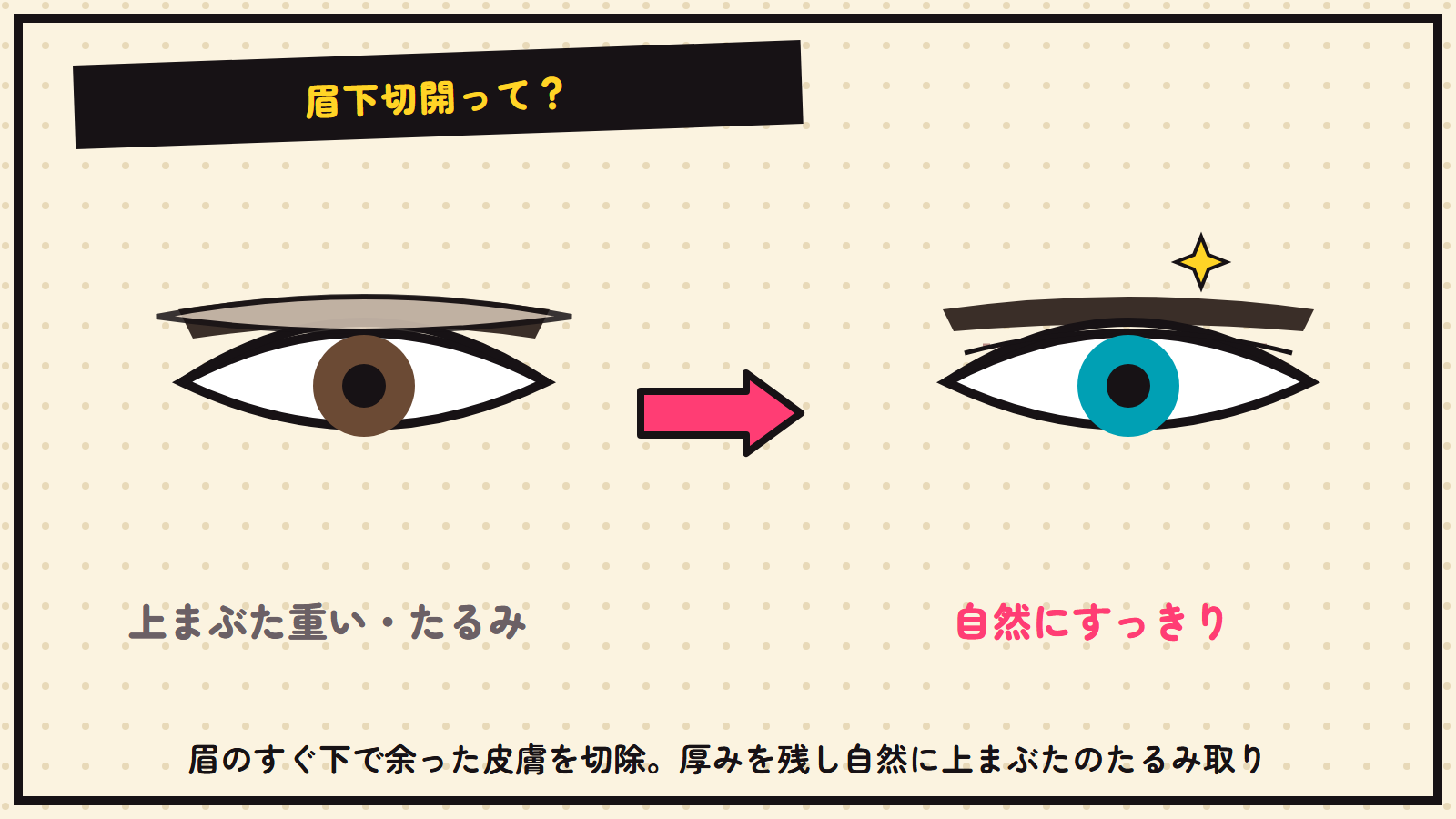 眉下切開の図解