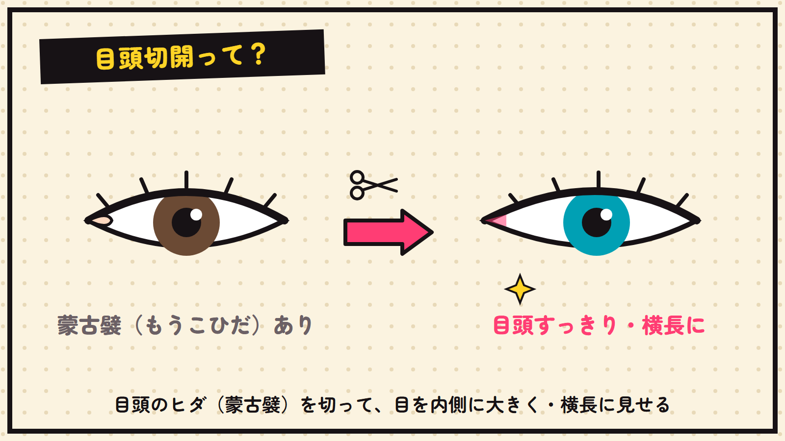 目頭切開の図解（蒙古襞を切って目を横長に）