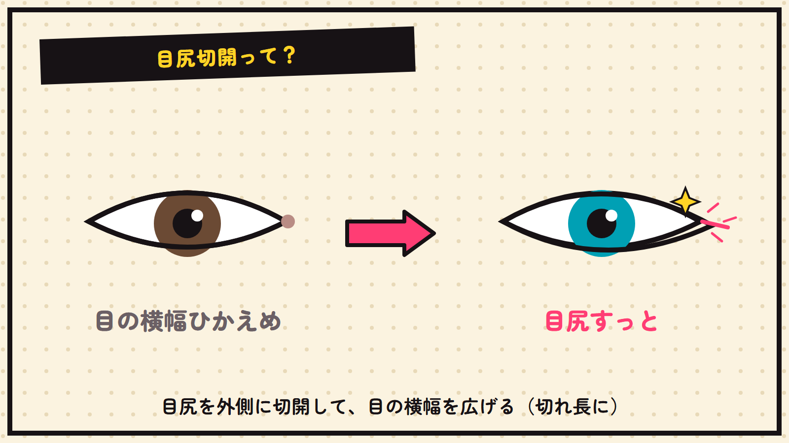 目尻切開の図解（目尻を外側に広げる）