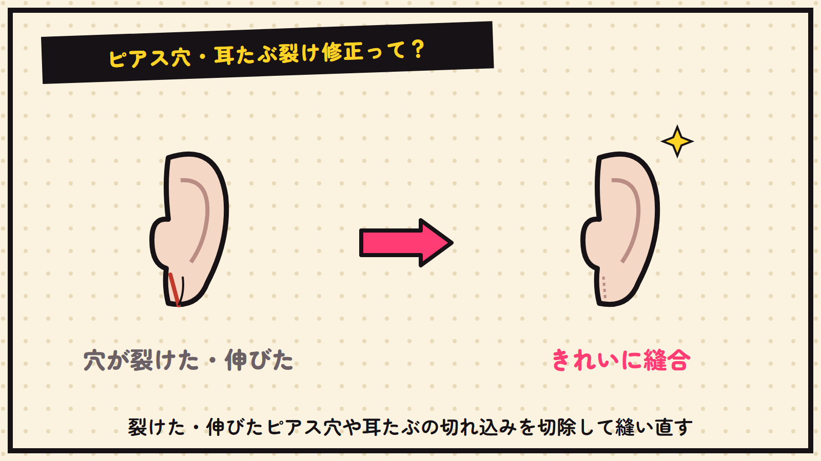 ピアス穴・耳たぶ裂け修正の図解